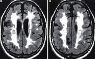 피질하 경색과 백질뇌증을 동반하는 상염색체 우성 뇌동맥질환