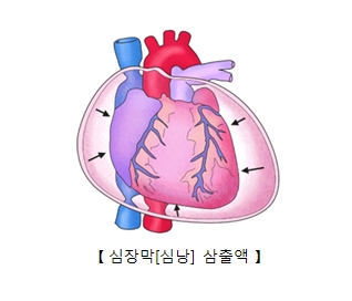심장막 삼출액